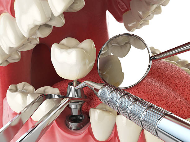 Best Emergency Dental Care for Broken or Chipped Teeth in Melbourne Beach, FL